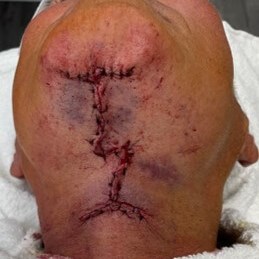 Immediate Post Procedure View